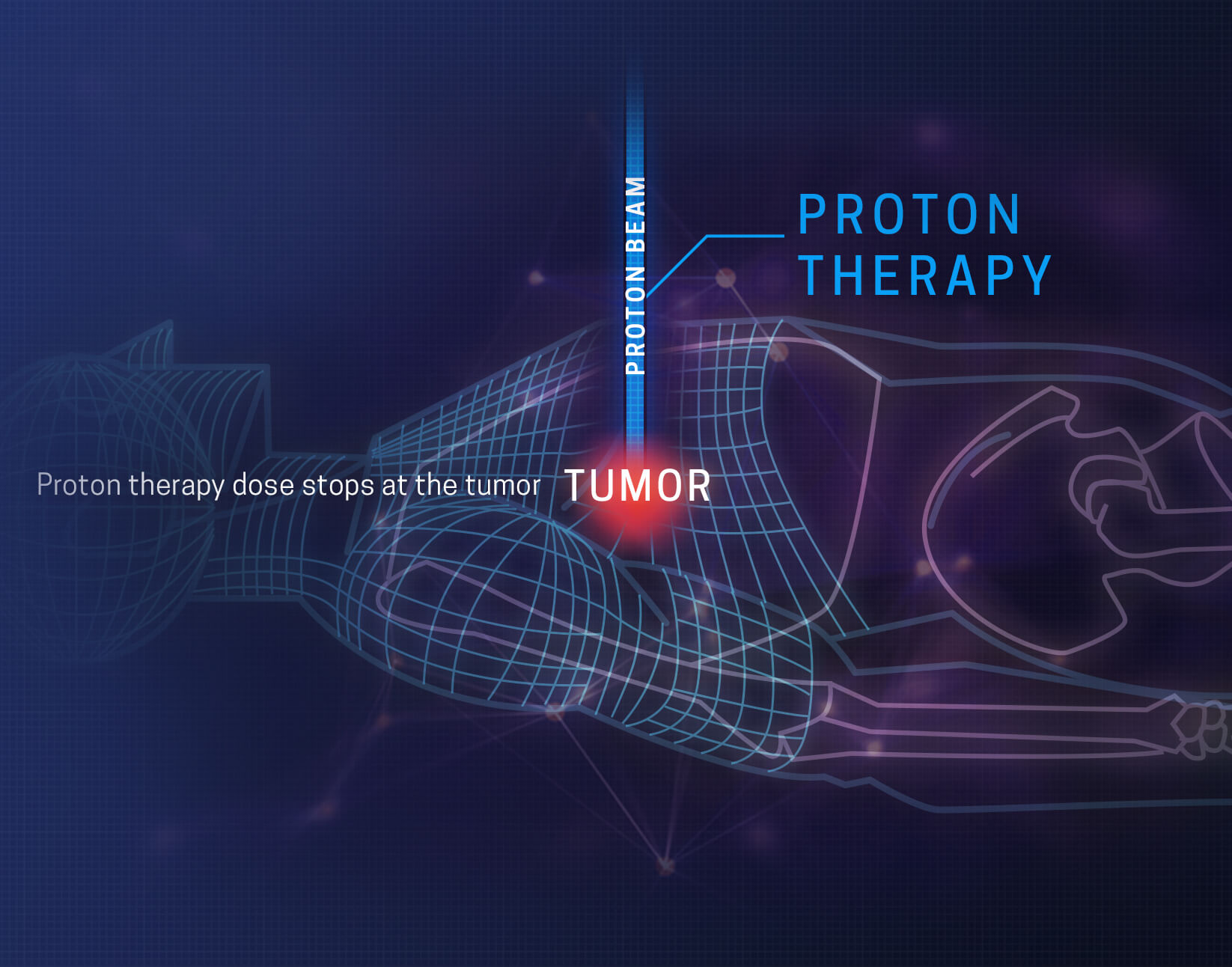 Benefícios da terapia de prótons da CA Protons em San Diego