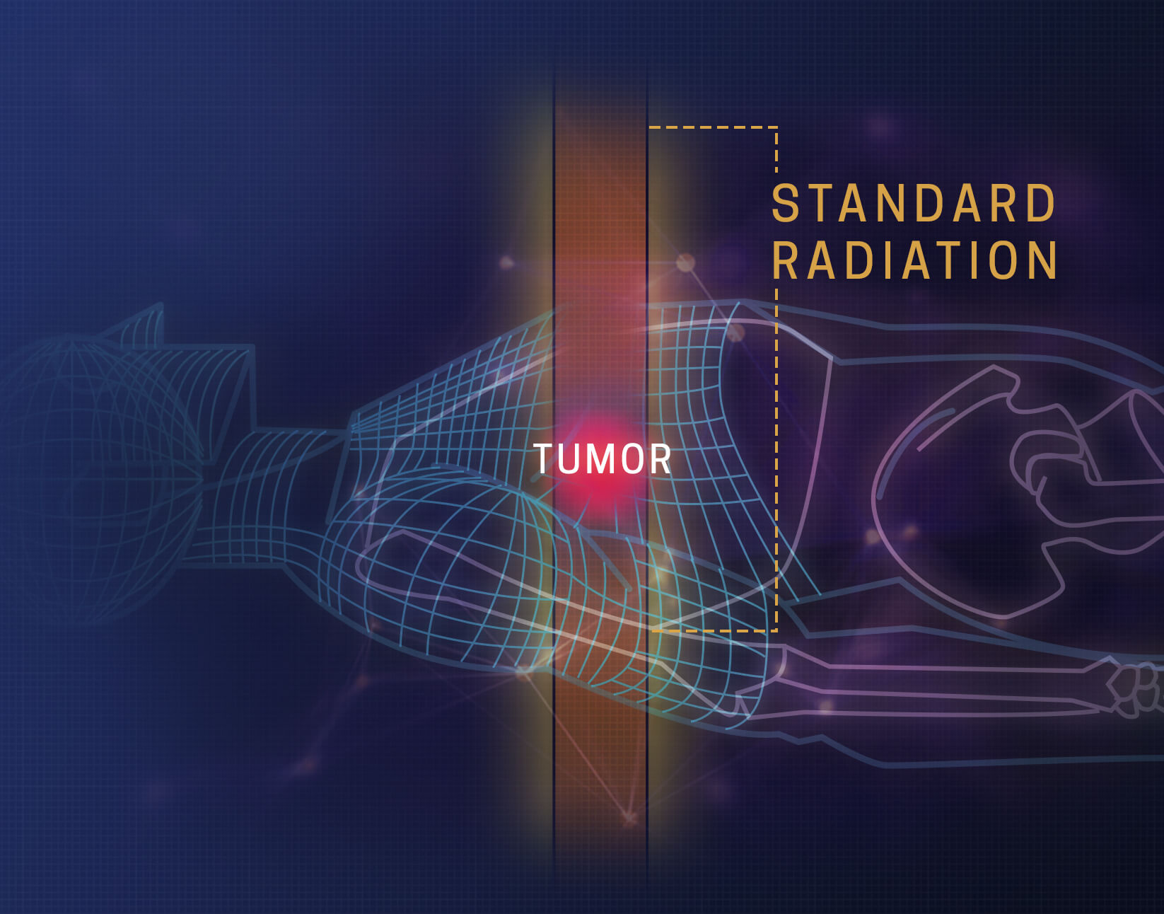 Proton Therapy vs. Radiation Standard
