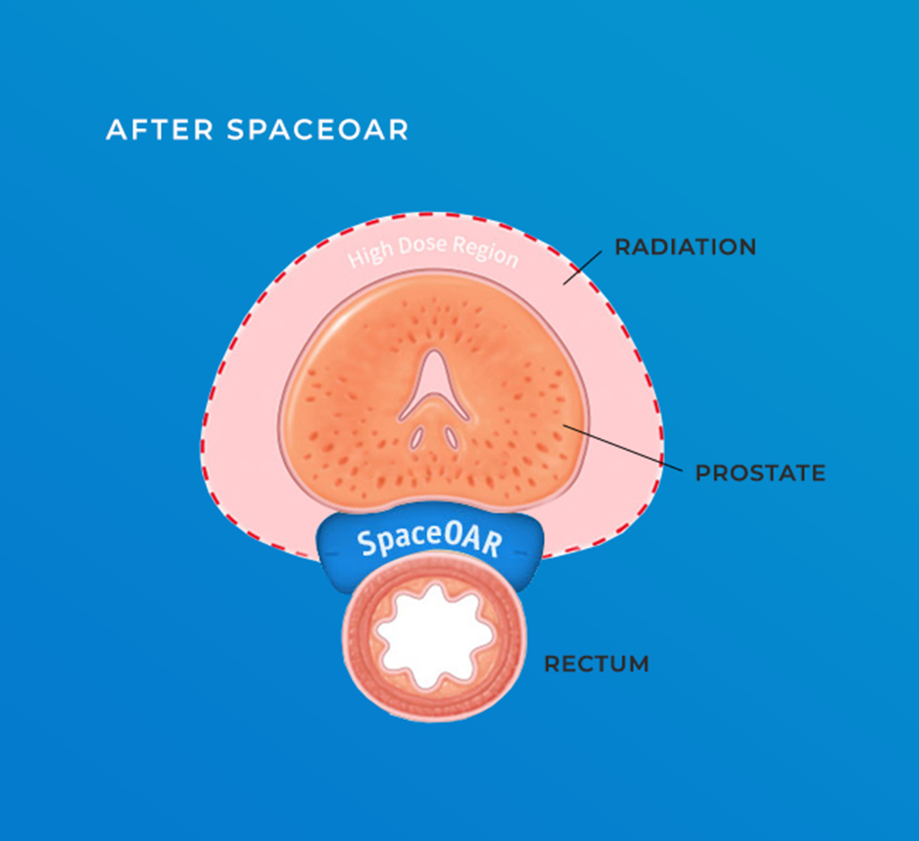 After SpaceOAR diagram