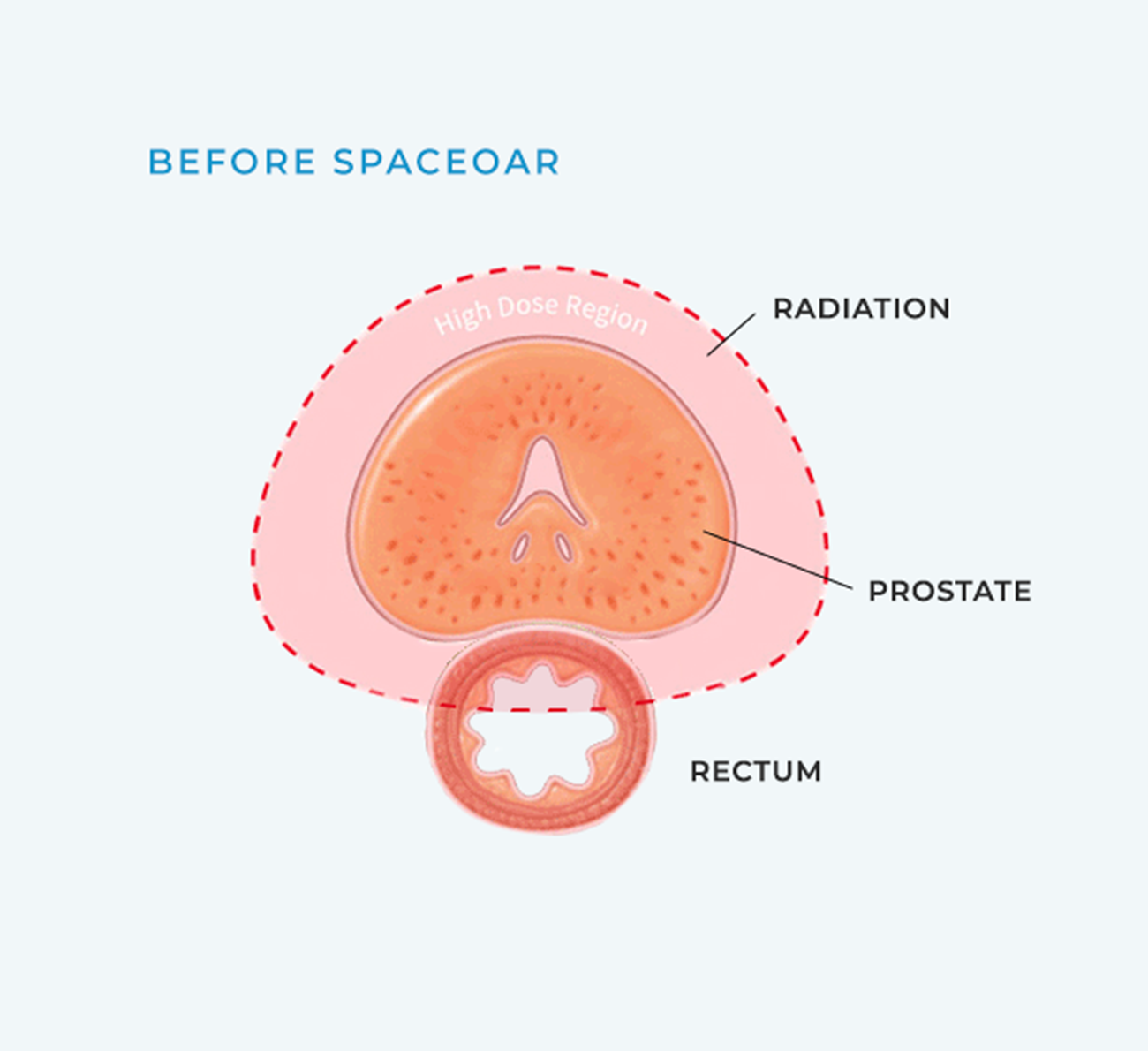 Before SpaceOAR diagram